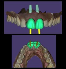 Implants